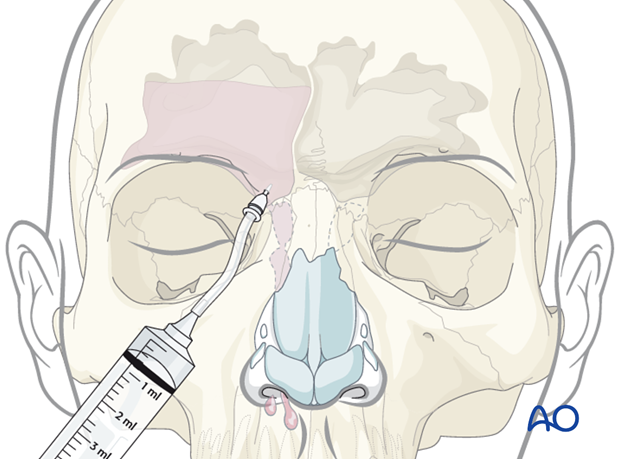 Endoscopic transnasal approach to the frontal sinus