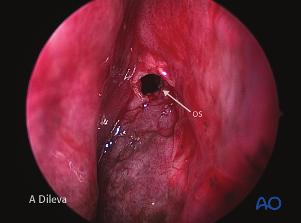 Endoscopic approach to the central skull base