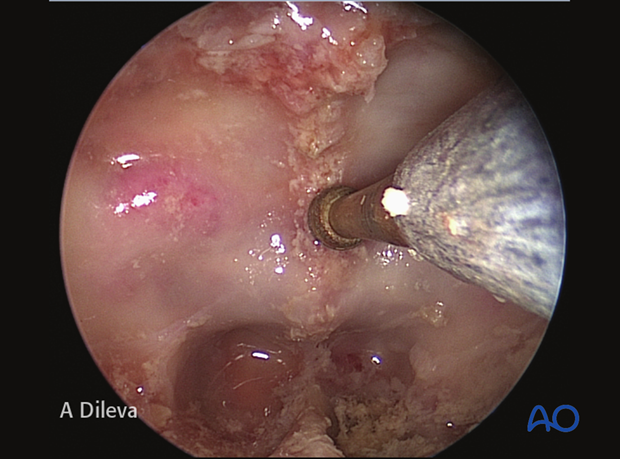Endoscopic approach to the central skull base