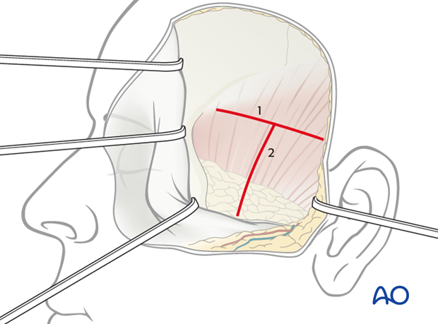 Lateral skull base approach