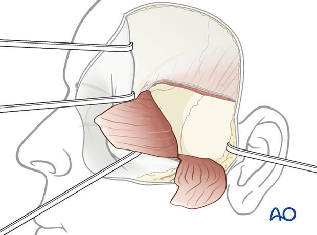 extradural middle fossa repair using temporal fascia flap
