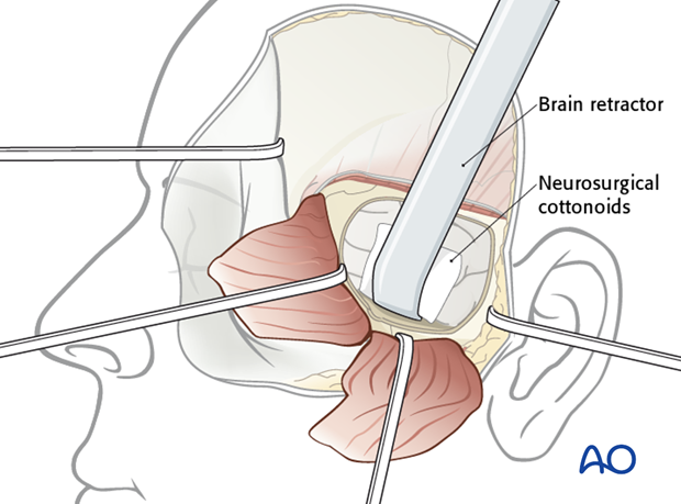 Lateral skull base approach