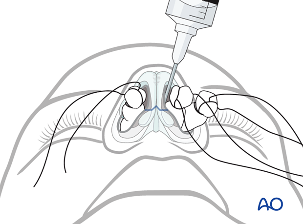 External rhinoplasty approach (open)
