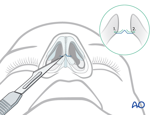 External rhinoplasty approach (open)