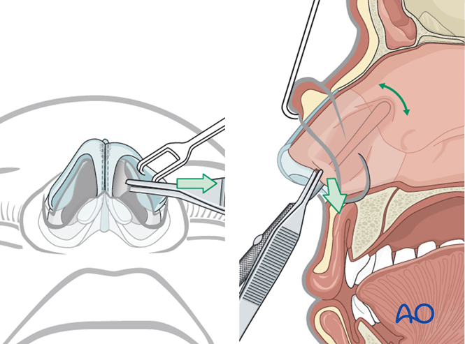 Transfixion Incision Rhinoplasty External rhinoplasty approach (open)