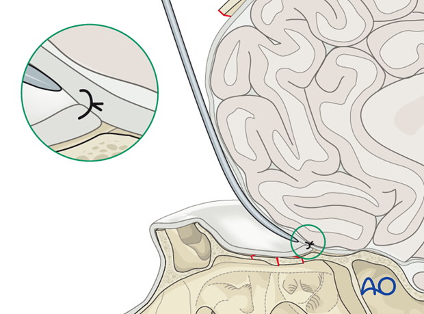 Frontobasal repair using pedicled periosteal flap