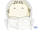 skull base anterior