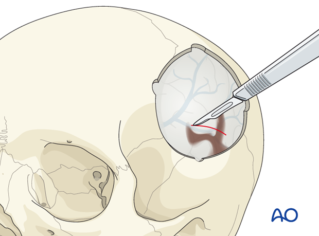 Treatment of depressed cranial vault fractures
