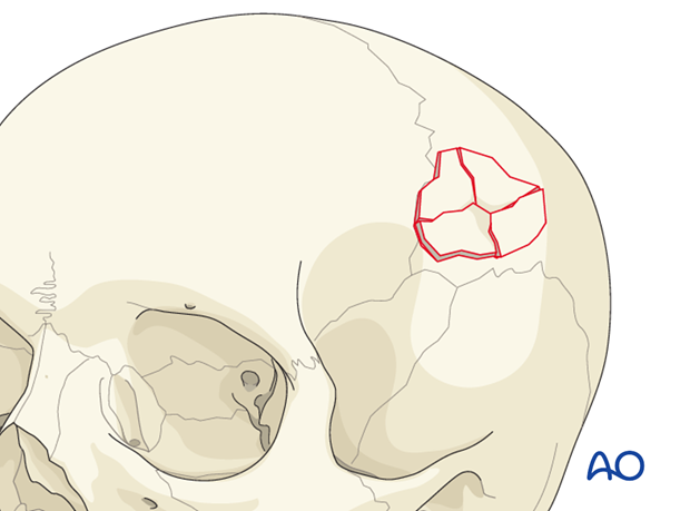 Diagnosis of cranial vault fractures
