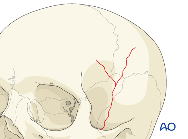 Diagnosis of cranial vault fractures