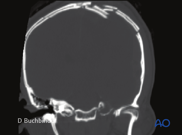 Diagnosis of cranial vault fractures