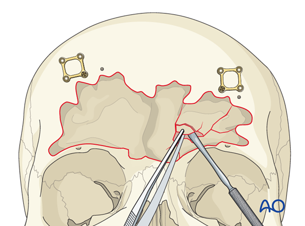 Posterior table removal