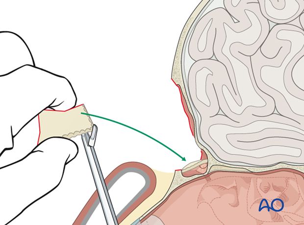 Closure of the outflow tract