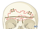 frontal sinus anterior table