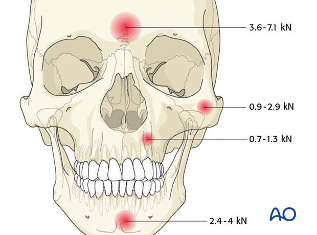 Diagnosis of frontal sinus fractures