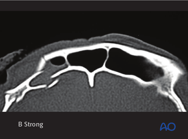 Diagnosis of frontal sinus fractures