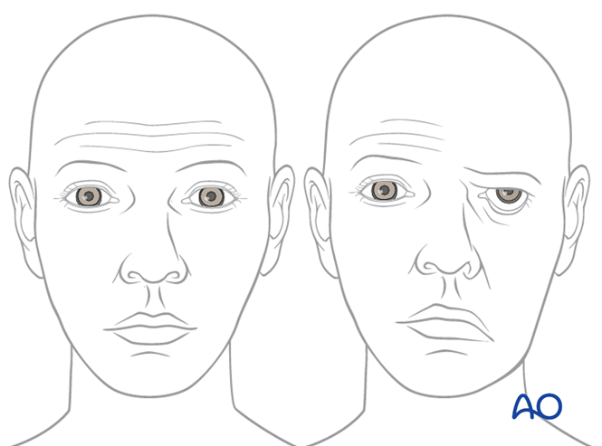 Observation for Temporal bone (lateral skull base)