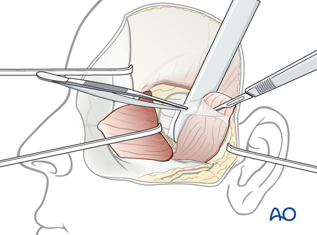 Extradural middle fossa repair using temporal fascia flap