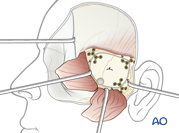 Extradural middle fossa repair using temporal fascia flap