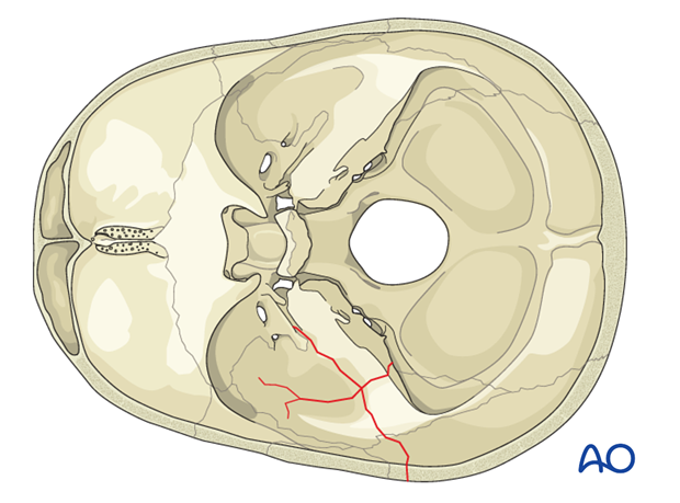 Classification of temporal bone fractures
