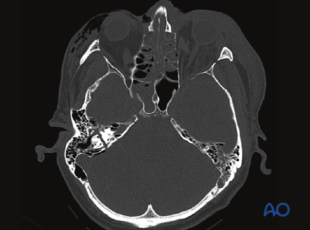 CT imaging of a temporal bone fracture
