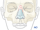 nasal bone