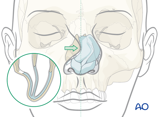 Open reduction for Nasal bone