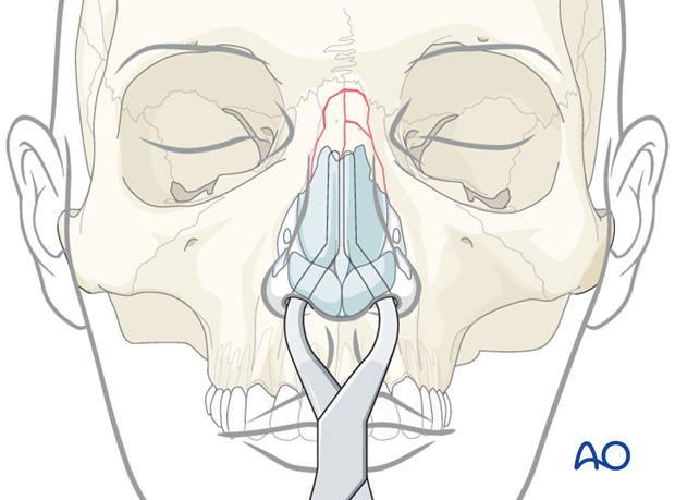 Reduction of the nasal septum