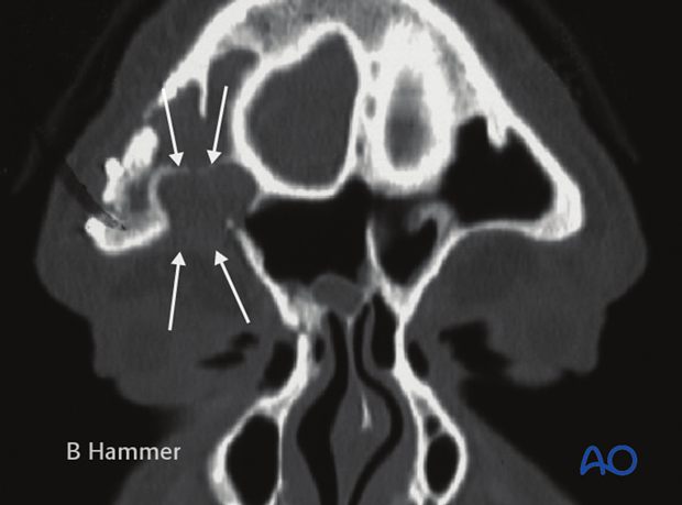 Case example: Partial obliteration of the frontal sinus 