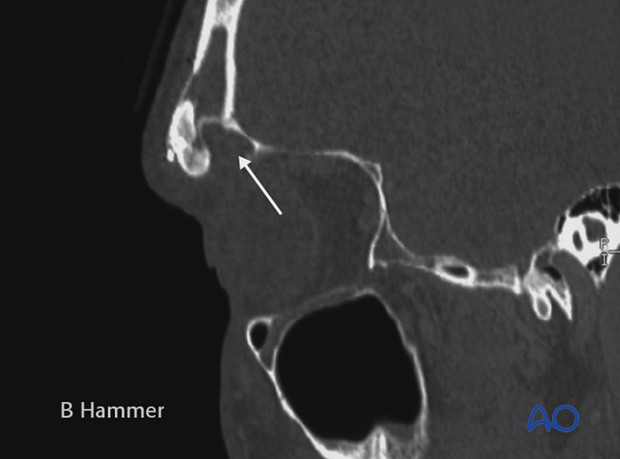 Case example: Partial obliteration of the frontal sinus 