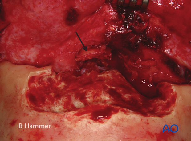 Case example: Infection of a hydroxyapatite graft