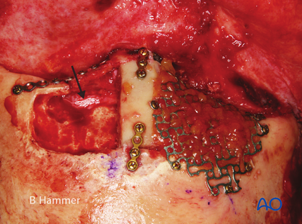 Case example: Infection of a hydroxyapatite graft