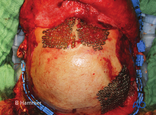 Case example: Infection of a hydroxyapatite graft