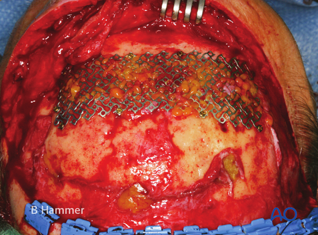 Case example: Infection of a PMMA graft causing recurrent fistulae