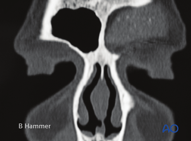 Case example: Infection of allogenic graft, causing swelling and chronic headache