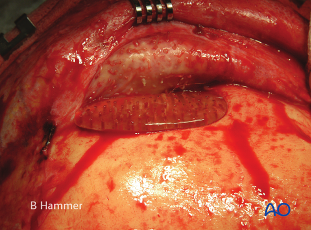 Case example: Infection of allogenic graft, causing swelling and chronic headache