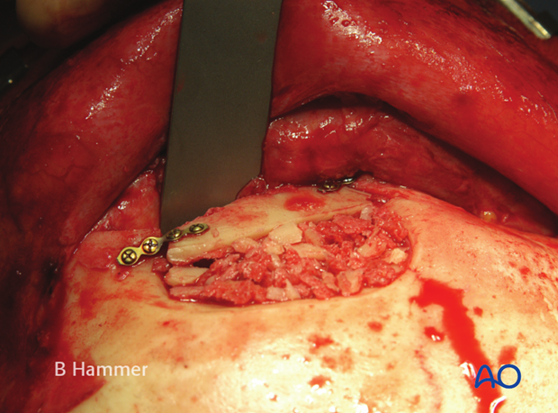 Case example: Infection of allogenic graft, causing swelling and chronic headache