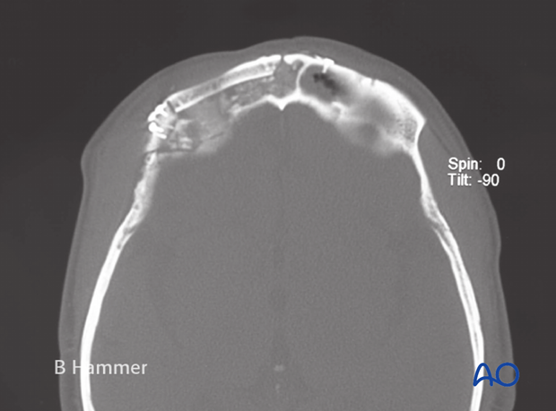 Case example: Osteomyelitis of the supraorbital rim with fistulization