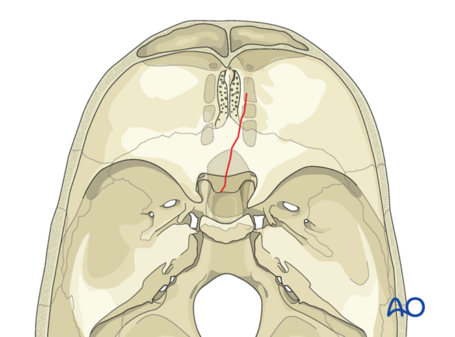 Skull base fracture, posterior