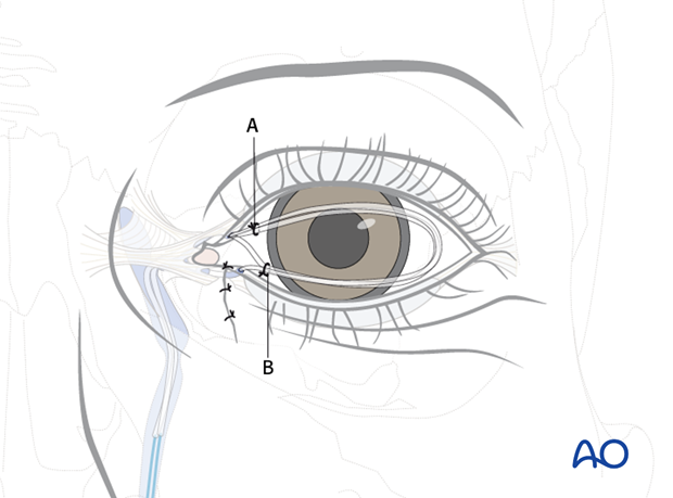 Repair of periorbital soft-tissue injuries and lacrimal system in NOE injuries