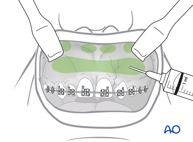approach to the le fort i level of the midface in cleft lip and palate patients
