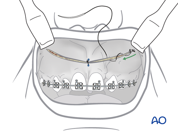 approach to the le fort i level of the midface in cleft lip and palate patients