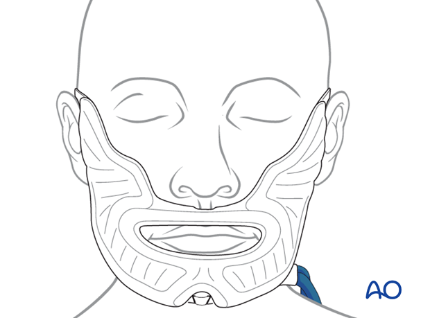 transoral approach to the mandibular angle
