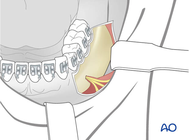 transoral approach to the lateral mandibular body