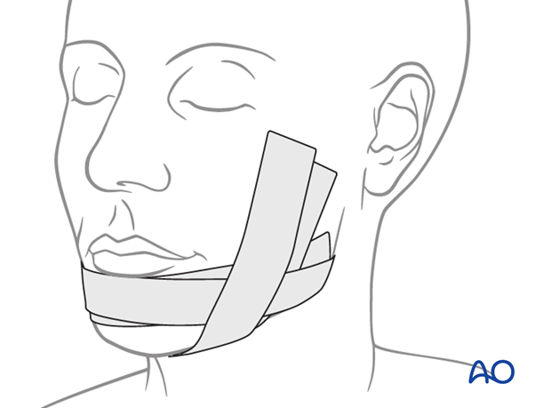 transoral approach to the chin