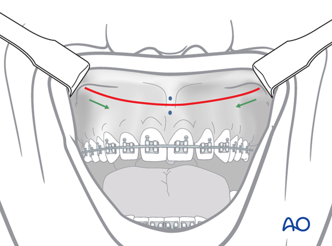 Approach to the Le Fort I level of the midface