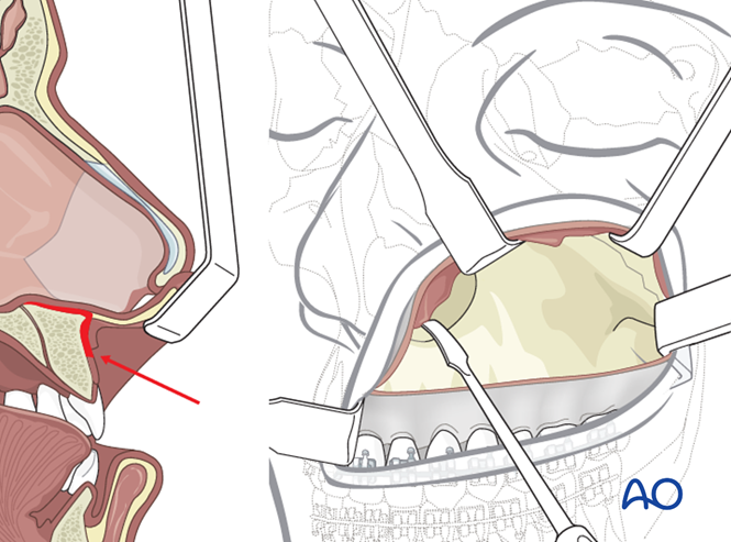 Approach to the Le Fort I level of the midface