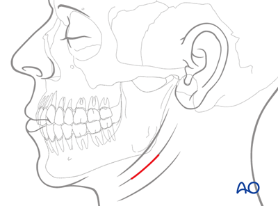 Submandibular approach