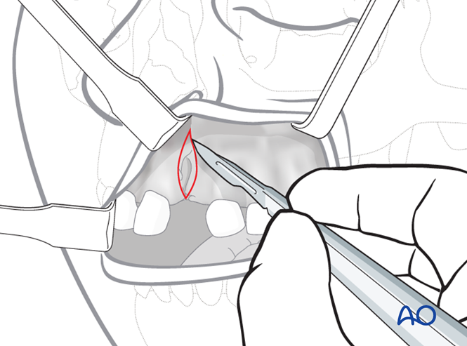 Cleft Bone Alveolar bone grafting for Unilateral cleft lip and/or palate