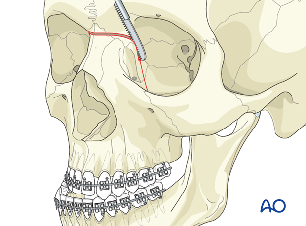 Le Fort II osteotomy for Syndromic synostosis